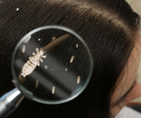 Lice (nits)